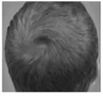 plasma rico en plaquetas en alopecia